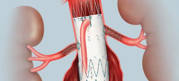 illustration of a Fenestrated endovascular aortic stent graft