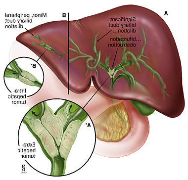 A: Extrahepatic tumor; B: intrahepatic tumor resulting in biliary duct dilation.