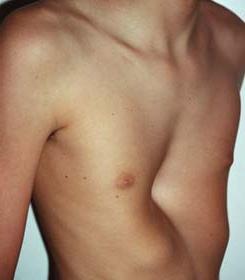 Picture of a severe pectus excavatum.