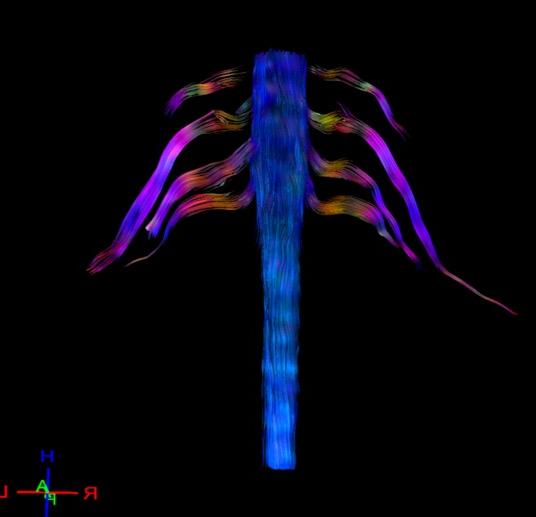 3-D tractography of the brachial plexus