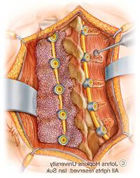 spinal fusion surgery